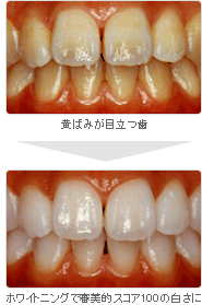 ホワイトニング